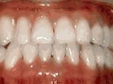 Under bite after