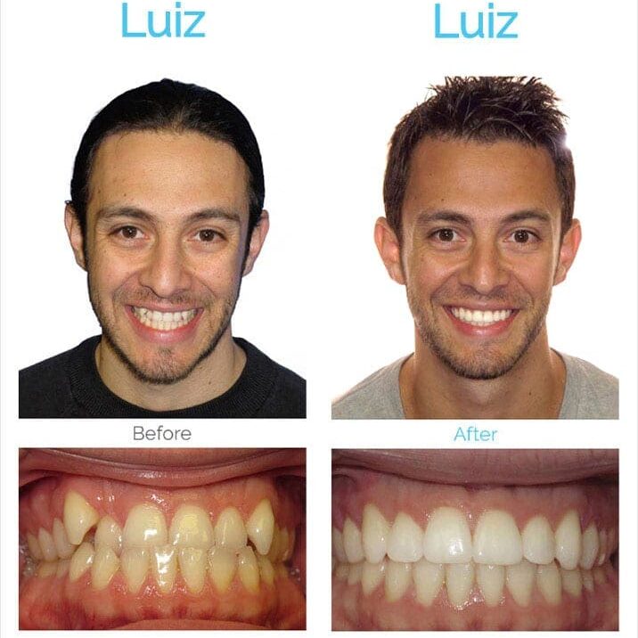 Before and after braces - Asheville NC adult patient Luiz - Roeder Orthodontics