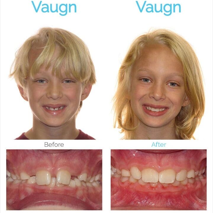 Before and after braces - Asheville NC pediatric patient Vaugn - Roeder Orthodontics